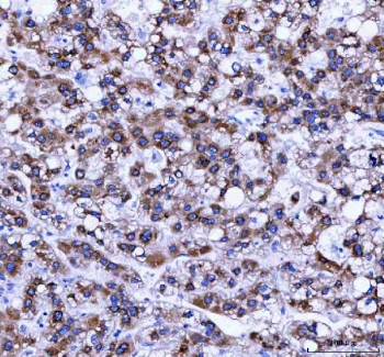 IHC staining of FFPE human liver cancer tissue with Ribosome binding protein 1 antibody. HIER: boil tissue sections in pH8 EDTA for 20 min and allow to cool before testing.