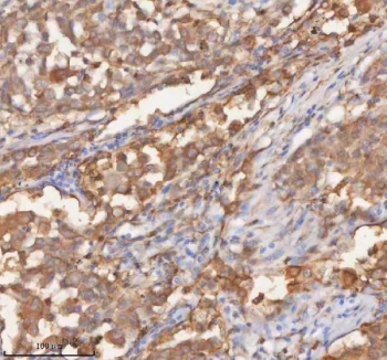 IHC staining of FFPE human lung adenocarcinoma tissue with SHKBP1 antibody. HIER: boil tissue sections in pH8 EDTA for 20 min and allow to cool before testing.