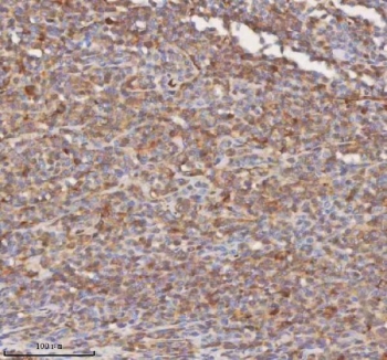 IHC staining of FFPE diffuse large B-cell lymphoma of human intestine tissue with SHKBP1 antibody. HIER: boil tissue sections in pH8 EDTA for 20 min and allow to cool before testing.