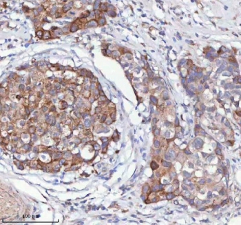 IHC staining of FFPE human breast cancer tissue with HAGH antibody. HIER: boil tissue sections in pH8 EDTA for 20 min and allow to cool before testing.