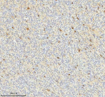 IHC staining of FFPE human glioblastoma tissue with HAGH antibody. HIER: boil tissue sections in pH8 EDTA for 20 min and allow to cool before testing.