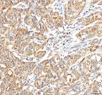 IHC staining of FFPE human urothelial carcinoma tissue with ITPA antibody. HIER: boil tissue sections in pH8 EDTA for 20 min and allow to cool before testing.