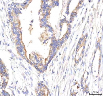 IHC staining of FFPE human pancreas ductal adenocarcinoma tissue with HEPACAM2 antibody. HIER: boil tissue sections in pH8 EDTA for 20 min and allow to cool before testing.