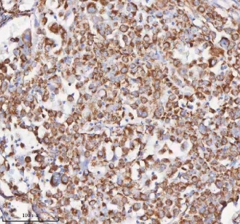 IHC staining of FFPE human lung adenocarcinoma tissue with SLC6A20 antibody. HIER: boil tissue sections in pH8 EDTA for 20 min and allow to cool before testing.