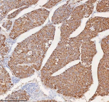 IHC staining of FFPE human liver cancer tissue with SLC6A20 antibody. HIER: boil tissue sections in pH8 EDTA for 20 min and allow to cool before testing.