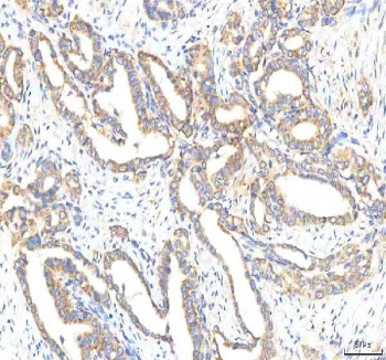 IHC staining of FFPE human thyroid papillary carcinoma tissue with OMI antibody. HIER: boil tissue sections in pH8 EDTA for 20 min and allow to cool before testing.