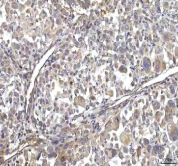 IHC staining of FFPE human lung cancer tissue with RASGRP3 antibody. HIER: boil tissue sections in pH8 EDTA for 20 min and allow to cool before testing.