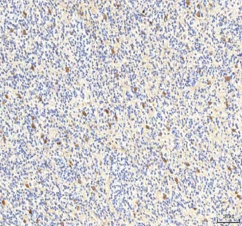 IHC staining of FFPE human glioblastoma tissue with PCMT1 antibody. HIER: boil tissue sections in pH8 EDTA for 20 min and allow to cool before testing.