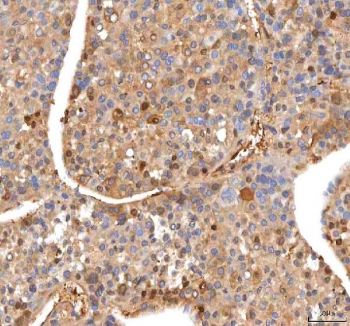 IHC staining of FFPE human liver cancer tissue with ISYNA1 antibody. HIER: boil tissue sections in pH8 EDTA for 20 min and allow to cool before testing.
