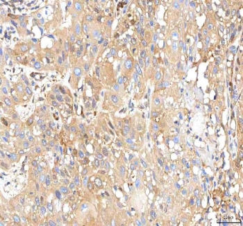 IHC staining of FFPE human urothelial carcinoma tissue with ISYNA1 antibody. HIER: boil tissue sections in pH8 EDTA for 20 min and allow to cool before testing.