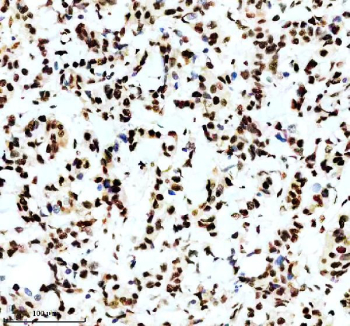IHC staining of FFPE human breast cancer tissue with Phospho-MDM2 antibody, HRP-secondary and DAB substrate. HIER: boil tissue sections in pH8 EDTA for 20 min and allow to cool before testing.