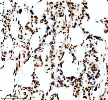 IHC staining of FFPE human breast cancer tissue with Phospho-MDM2 antibody, HRP-secondary and DAB substrate. HIER: boil tissue sections in pH8 EDTA for 20 min and allow to cool before testing.