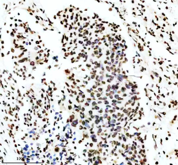 IHC staining of FFPE human lung cancer tissue with Phospho-MDM2 antibody, HRP-secondary and DAB substrate. HIER: boil tissue sections in pH8 EDTA for 20 min and allow to cool before testing.