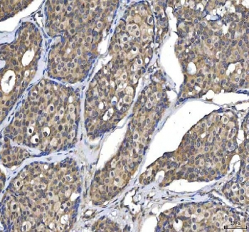 IHC staining of FFPE human breast cancer tissue with HTT antibody. HIER: boil tissue sections in pH8 EDTA for 20 min and allow to cool before testing.