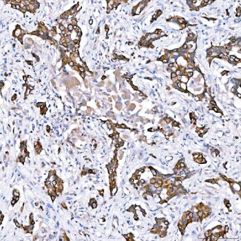 IHC staining of FFPE human lung adenocarcinoma tissue with Cytokeratin 4 antibody. HIER: boil tissue sections in pH8 EDTA for 20 min and allow to cool before testing.