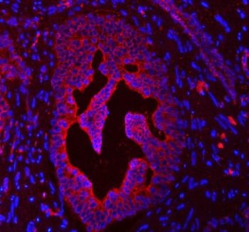 Immunofluorescent staining of FFPE human prostate cancer tissue with Cytokeratin 4 antibody (red) and DAPI nuclear stain (blue). HIER: steam section in pH8 EDTA buffer for 20 min.