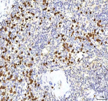 S100A12 Antibody Rabbit Polyclonal in human spleen tissue. Immunohistochemistry staining of FFPE human spleen demonstrates cytoplasmic staining in numerous scattered inflammatory cells consistent with the known expression of S100 calcium binding protein A12 / S100A12 in neutrophils and other myeloid-derived cells. Brown chromogenic signal highlights S100A12-positive inflammatory cells within splenic tissue while surrounding lymphoid populations remain largely negative. Heat-induced epitope retrieval was performed by boiling tissue sections in pH 8 EDTA buffer for 20 min before staining.