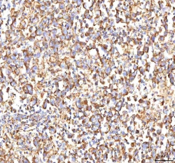 IHC staining of FFPE human testicular seminoma tissue with CALR antibody. HIER: boil tissue sections in pH8 EDTA for 20 min and allow to cool before testing.
