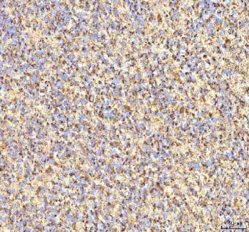 IHC staining of FFPE human glioblastoma tissue with CALR antibody. HIER: boil tissue sections in pH8 EDTA for 20 min and allow to cool before testing.