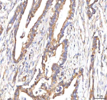 IHC staining of FFPE human pancreas ductal adenocarcinoma tissue with HSD17B13 antibody. HIER: boil tissue sections in pH8 EDTA for 20 min and allow to cool before testing.