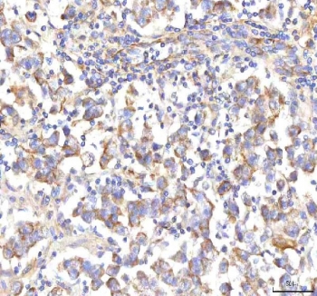 IHC staining of FFPE human testicular seminoma tissue with HSD17B13 antibody. HIER: boil tissue sections in pH8 EDTA for 20 min and allow to cool before testing.