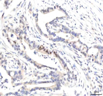 IHC staining of FFPE human pancreas ductal adenocarcinoma tissue with IPO8 antibody. HIER: boil tissue sections in pH8 EDTA for 20 min and allow to cool before testing.