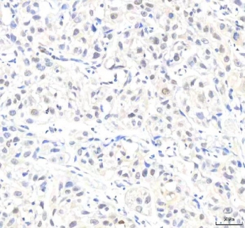 IHC staining of FFPE human urothelial carcinoma tissue with IPO8 antibody. HIER: boil tissue sections in pH8 EDTA for 20 min and allow to cool before testing.