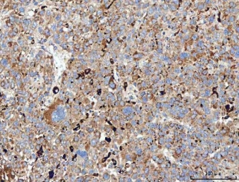 CD206 Antibody Human Liver Cancer IHC. Immunohistochemical staining of FFPE human liver cancer tissue using CD206 Antibody / Macrophage Mannose Receptor Antibody demonstrates widespread cytoplasmic and membranous HRP-DAB brown staining throughout the tumor microenvironment, including scattered immune cell populations and stromal-associated elements. The staining pattern is consistent with expression of CD206 (MRC1), a C-type lectin receptor involved in carbohydrate recognition, receptor-mediated endocytosis, antigen processing, and macrophage-mediated immune regulation. Positive immunoreactivity is compatible with tumor-associated macrophages and other antigen-presenting cell populations that contribute to immune modulation, tissue remodeling, and cellular communication within the hepatic tumor microenvironment. HIER: boil tissue sections in pH8 EDTA for 20 min and allow to cool before testing.