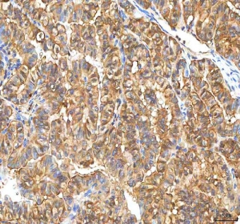 IHC staining of FFPE human thyroid papillary carcinoma tissue with Pyridoxal kinase antibody. HIER: boil tissue sections in pH8 EDTA for 20 min and allow to cool before testing.
