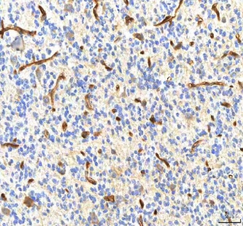 IHC staining of FFPE human glioblastoma tissue with Pyridoxal kinase antibody. HIER: boil tissue sections in pH8 EDTA for 20 min and allow to cool before testing.