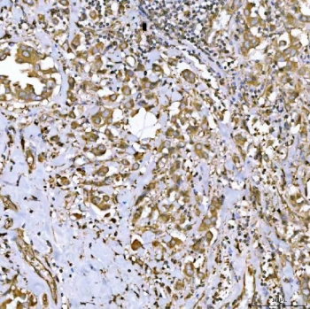 IHC staining of FFPE human breast cancer tissue with GlnRS antibody. HIER: boil tissue sections in pH8 EDTA for 20 min and allow to cool before testing.