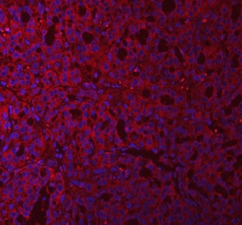 Immunofluorescent staining of FFPE human thyroid carcinoma tissue with GlnRS antibody (red) and DAPI nuclear stain (blue). HIER: steam section in pH8 EDTA buffer for 20 min.