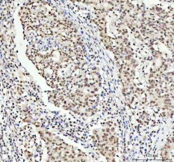 TARDBP Antibody Colorectal Adenocarcinoma Immunohistochemistry. IHC staining of FFPE human colorectal adenocarcinoma tissue with TARDBP antibody. HIER: boil tissue sections in pH8 EDTA for 20 min and allow to cool before testing.