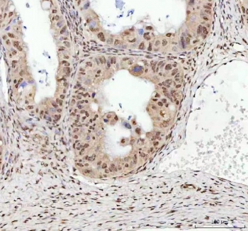 TARDBP Antibody Ovarian Cancer Immunohistochemistry. staining of FFPE human ovarian cancer tissue with TARDBP antibody. HIER: boil tissue sections in pH8 EDTA for 20 min and allow to cool before testing.