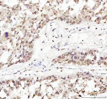TARDBP Antibody Liver Cancer Immunohistochemistry. IHC staining of FFPE human liver cancer tissue with TARDBP antibody. HIER: boil tissue sections in pH8 EDTA for 20 min and allow to cool before testing.