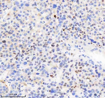 IHC staining of FFPE human liver cancer tissue with MACROH2A2 antibody. HIER: boil tissue sections in pH8 EDTA for 20 min and allow to cool before testing.