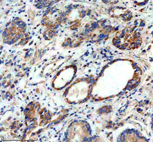 MRPS31 Antibody 29M40 in Human Stomach Cancer IHC. Immunohistochemistry staining of FFPE human stomach cancer tissue with MRPS31 Antibody 29M40 / Mitochondrial Ribosomal Protein S31 Antibody, clone 29M40, at 1:50 overnight at 4oC. HIER was performed using EDTA buffer, pH 8.0, followed by blocking with 10% goat serum. HRP/DAB detection demonstrates MRPS31 staining in human stomach cancer tissue.