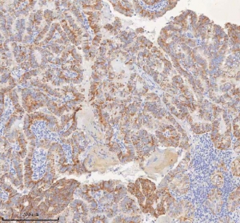 IHC staining of FFPE human thyroid papillary carcinoma tissue using MINDY4 antibody. Brown chromogenic signal indicates MINDY4-positive tumor cells with predominantly cytoplasmic staining. Staining of formalin-fixed tissues requires heating tissue sections in pH 8 EDTA buffer for 20 minutes followed by cooling at RT before testing.