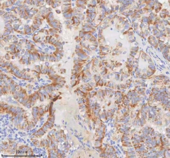 IHC staining of FFPE human thyroid papillary carcinoma tissue with MINDY4 antibody. HIER: boil tissue sections in pH8 EDTA for 20 min and allow to cool before testing.