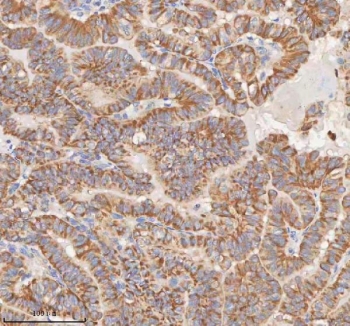 IHC staining of FFPE human thyroid papillary carcinoma tissue with MIPEP antibody. HIER: boil tissue sections in pH8 EDTA for 20 min and allow to cool before testing.