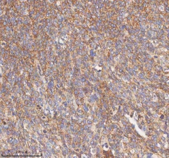 IHC staining of FFPE human cervix squamous cell carcinoma tissue with HDHD5 antibody. HIER: boil tissue sections in pH8 EDTA for 20 min and allow to cool before testing.