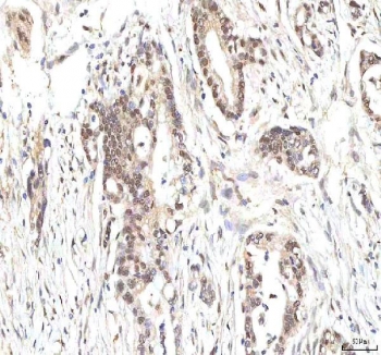 IHC staining of FFPE human pancreas ductal adenocarcinoma tissue with PHF6 antibody. HIER: boil tissue sections in pH8 EDTA for 20 min and allow to cool before testing.