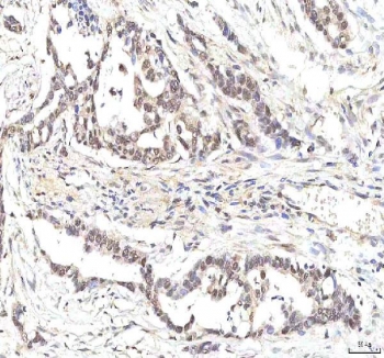 IHC staining of FFPE human pancreas ductal adenocarcinoma tissue with PHF6 antibody. HIER: boil tissue sections in pH8 EDTA for 20 min and allow to cool before testing.