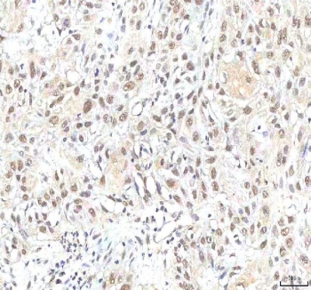 IHC staining of FFPE human urothelial carcinoma tissue with PHF6 antibody. HIER: boil tissue sections in pH8 EDTA for 20 min and allow to cool before testing.