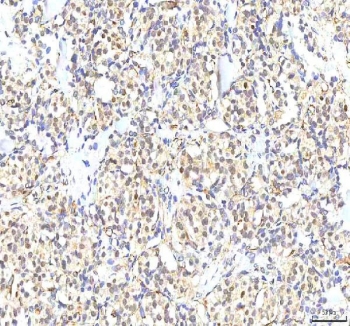 IHC staining of FFPE human lung cancer tissue with PHF6 antibody. HIER: boil tissue sections in pH8 EDTA for 20 min and allow to cool before testing.