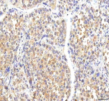 IHC staining of FFPE human liver cancer tissue with PHF6 antibody. HIER: boil tissue sections in pH8 EDTA for 20 min and allow to cool before testing.