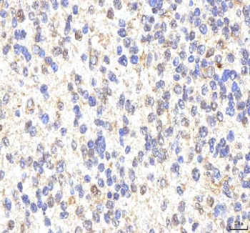 IHC staining of FFPE human glioblastoma tissue with PHF6 antibody. HIER: boil tissue sections in pH8 EDTA for 20 min and allow to cool before testing.
