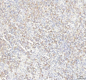IHC staining of FFPE human testicular seminoma tissue with Phosphoglucomutase 3 antibody. HIER: boil tissue sections in pH8 EDTA for 20 min and allow to cool before testing.