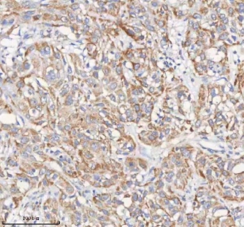 IHC staining of FFPE human urothelial carcinoma tissue with PCCA antibody. HIER: boil tissue sections in pH8 EDTA for 20 min and allow to cool before testing.