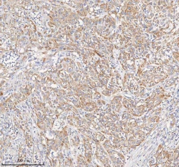 IHC staining of FFPE human urothelial carcinoma tissue with PCCA antibody. HIER: boil tissue sections in pH8 EDTA for 20 min and allow to cool before testing.